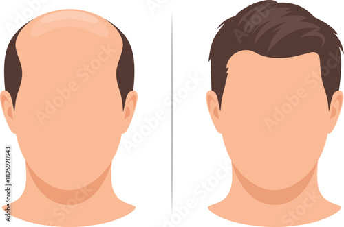 Hair Loss and Hair Restoration Vector Comparison