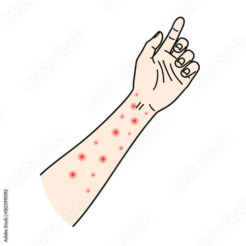 Allergy skin test showing red welts on arm with raised hand  