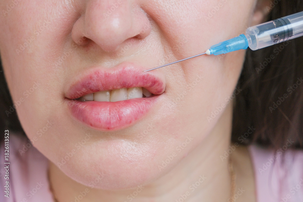 Obraz premium A woman gets hyaluronic acid injected into her lips. She's afraid to give injections.