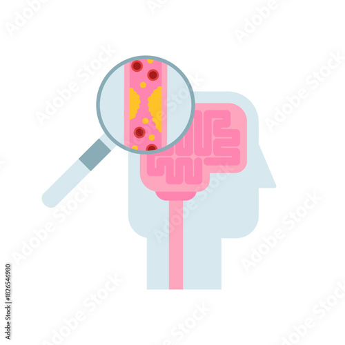 Intracranial atherosclerotic disease (ICAD) medical infographic. Flat diagram of cholesterol plaque brain blood vessel. Hyperlipidemia cardiovascular disease vector illustration.