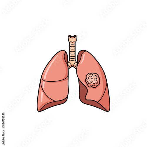 Illustration of Lungs with Tumor, Depicting Lung Cancer.