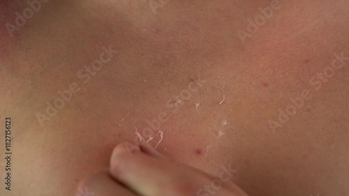 Man rubbing peeling sunburned skin in close-up, 4K
