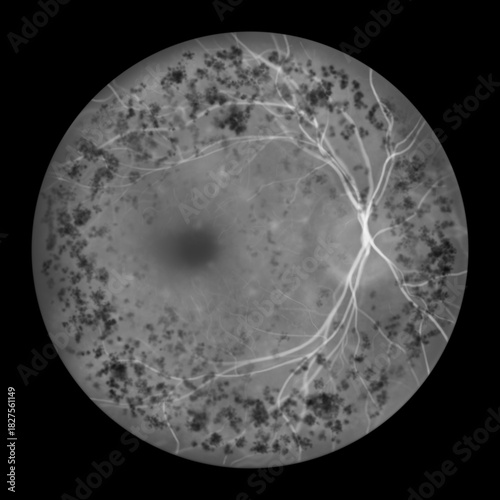 Autosomal dominant vitreoretinochoroidopathy, illustration