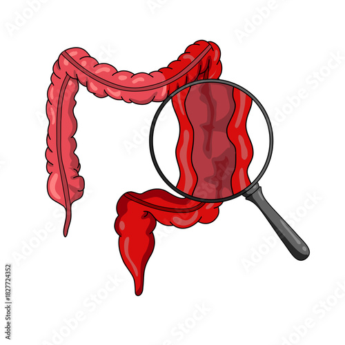 Illustration of ulcerative colitis, inflammatory bowel disease. Inflammation of the human digestive system. Vector illustration for medical, science, and educational posters