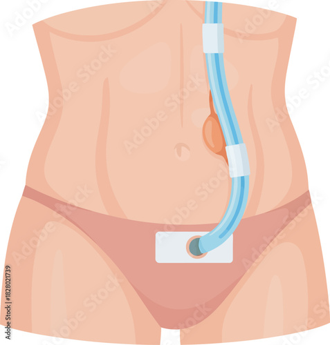 Illustration of a human torso with a medical tube inserted for treatment.