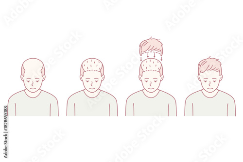 four caucasian men showing hair progression across four stages, minimalist line art portrait, sequential scalp