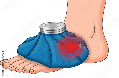 Vector Illustration of a Foot with an Injury Receiving Cold Therapy Using a Blue Ice Bag for Swelling and Pain Relief Treatment.