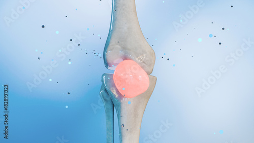 Valokuva knee undergoing the healing process, knee pain, joint disorder, cartilage damage