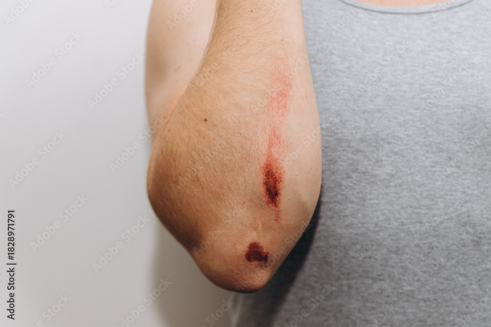 Naklejka premium Close-up of a fresh skin abrasion or scrape injury on a person's elbow and arm, showing blood and damaged skin against a white and gray background.