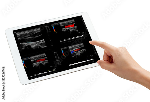 Contemporary medical imaging: An ultrasound of the carotid artery displayed on a sleek tablet, highlighting the integration of technology in health diagnostics