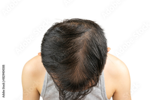 Top view of a middle-aged Asian man's head showing male pattern baldness (androgenic alopecia) with thinning hair and visible scalp on the crown, indicating hair loss and receding hairline problem.