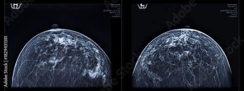 Mammogram analysis showing breast tissue with various patterns and structures. The scans help in examining for potential abnormalities in women's health.