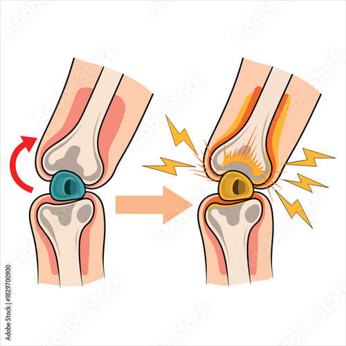 Normal knee joint movement causes pain and injury in human body, represented with arrows