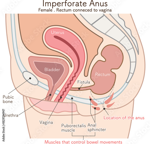 女性の鎖肛_直腸膣ろう_imperforate anus(ARM) illustration