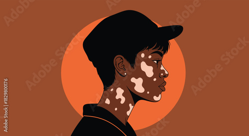 A beautiful and confident person with vitiligo skin condition shown in a side profile portrait promoting body positivity.