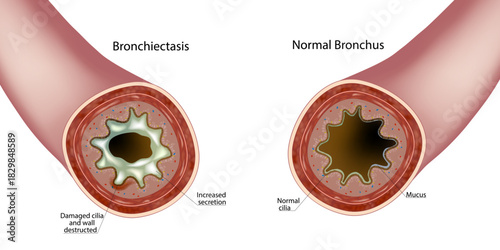 Bronchiectasis and Normal Bronchus Cross Section Medical Illustration. Airway Damage Comparison in Bronchiectasis Anatomy Diagram