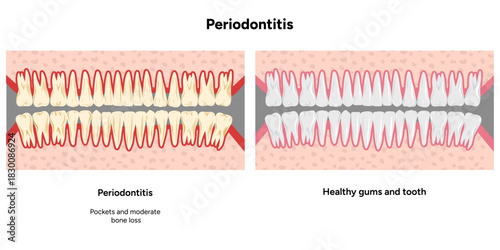 Hand-drawn dental illustration featuring the expanded upper and lower rows of teeth with periodontal problems compared side-by-side with healthy teeth