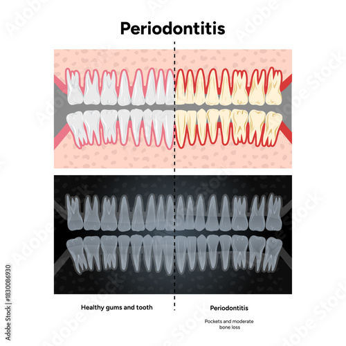 Hand-drawn dental illustration featuring expanded upper and lower rows of teeth with periodontal problems, healthy teeth. Computer tomography (CT) scans that highlight bone loss, gum recession 