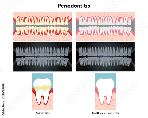Upper and lower rows of teeth with periodontal problems to healthy teeth. Computer tomography (CT) sscans and anatomical cross-sections of both a healthy tooth and a tooth affected by periodontitis