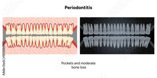 Hand-drawn dental illustration featuring expanded upper and lower rows of teeth with periodontal problems. Computer tomography (CT) scans that highlight bone loss, gum recession 