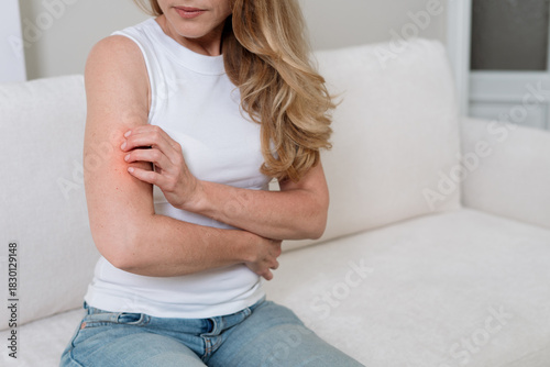 Vászonkép Persistent discomfort from eczema on the arm of a mature woman at home