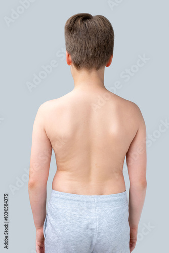 Child's back showing spinal curvature comparison, scoliosis pain, kyphosis, orthopedic treatment or physical therapy, Posture correction growing bodies and spinal health, anatomy Medical illustration