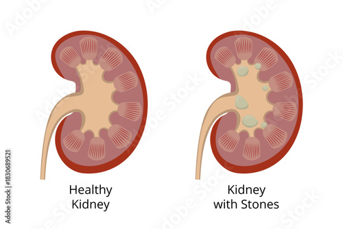 Healthy kidney compared to kidney with kidney stones forming inside