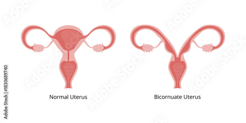 Normal Uterus and Bicornuate Uterus Showing Difference in Shape