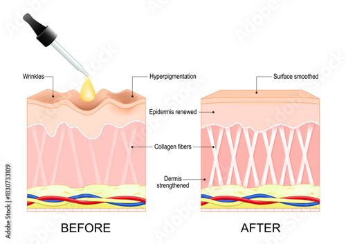 Skin changes Before and After retinol serum treatment. Antiaging cosmetic procedure