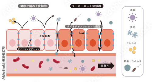 リーキーガット症候群をわかりやすく表した小腸上皮細胞の断面図