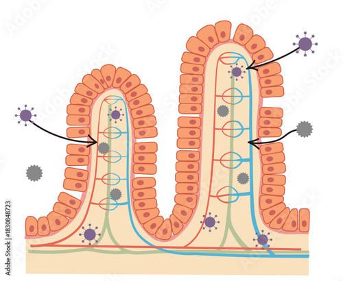 小腸の上皮細胞の断面イラストとリーキーガット症候群をわかりやすく表したイラスト
