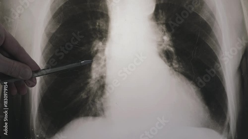 Doctor learn X-ray picture with pneumonia, fluorography. Diagnostics of human lung and respiratory tract diseases. 4k footage.