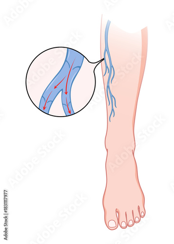Varicose veins. Blue blood vessel visible through the skin, abnormally swollen leg. Vascular disease diagnostic and treatment. Venous insufficiency medical disease
