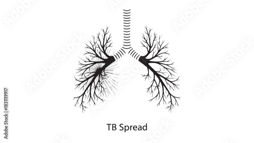 Illustration Demonstrating TB Spread Through Lungs and Airways.