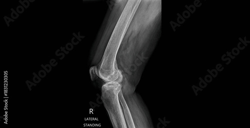 
Knee x-ray lateral standing view showing femur, tibia, fibula and patella. Weight-bearing radiograph for diagnostic examination of knee joint alignment and arthritis