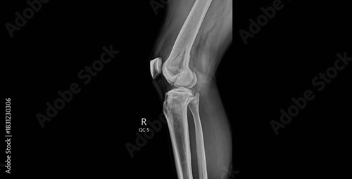 Bild auf Leinwand Knee x-ray lateral standing view showing femur, tibia, fibula and patella