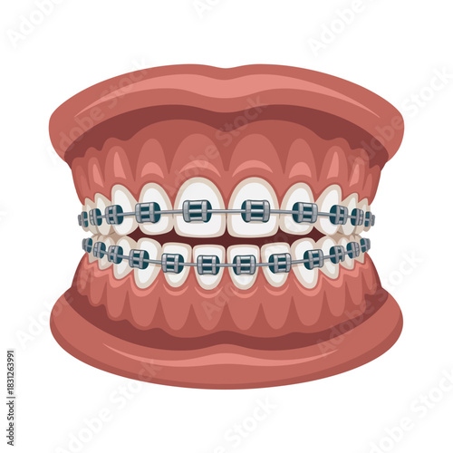 A detailed illustration of human teeth with metallic braces to straighten them.