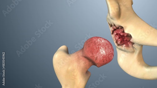 Medical Visualization of Hip Dysplasia Impacting Leg Bone