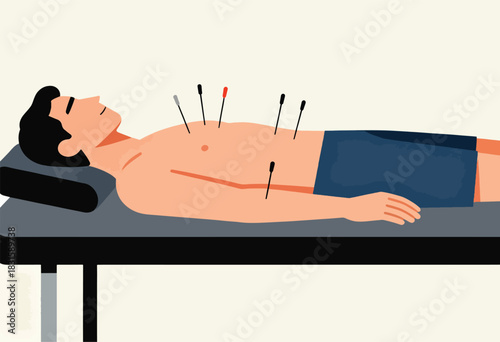 An illustration shows a man lying down receiving acupuncture treatment with needles inserted into his body