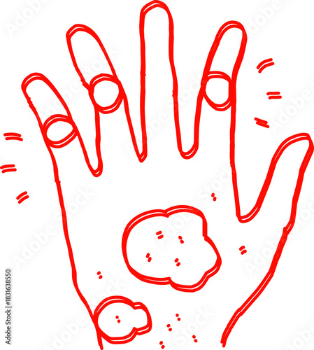 Red line-art illustration of a human hand showing highlighted joints and marked skin areas, ideal for medical, dermatology, and health-related educational designs.
