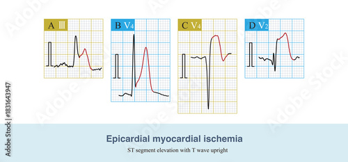 When epicardial coronary artery thrombosis occurs, the lumen is completely  or subtotal occluded, ischemia affects epicardial myocardium, and ST segment elevation with T wave upright of the ECG.
