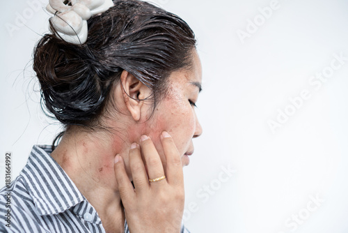 Asian woman suffering from hair dye allergy, showing itchiness, facial and neck scratching, and irritated scalp. Visible rash and redness , chemical sensitivity, allergic reactions,