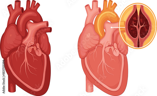 Healthy Human Heart vs. Heart Valve Disease and Blood Clot Illustration