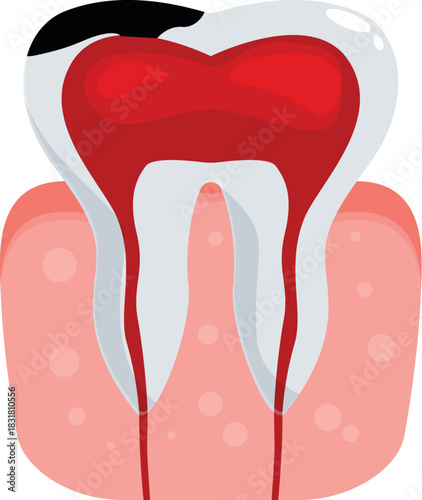 Pulpitis showing inflamed and bleeding tooth pulp chamber with decayed enamel requiring urgent endodontic treatment