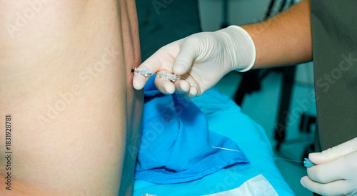 An anesthesiologist administers spinal anesthesia to a patient using a special needle. A close-up of the anesthesiologist's hands, wearing sterile gloves, holding an epidural anesthesia needle.