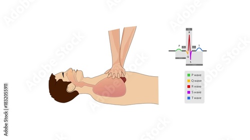 2D medical animation showing correct CPR chest compression technique on an unconscious person for resuscitation training