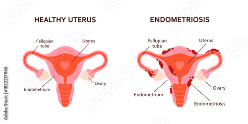Healthy Uterus and Endometriosis Comparison Vector Illustration. Flat Medical Anatomy Graphic Showing Normal Reproductive System Versus Endometrial Lesions for Gynecology Education