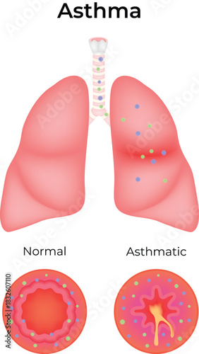 Asthma Normal vs Asthmatic Lungs and Bronchioles Comparison Vector Illustration