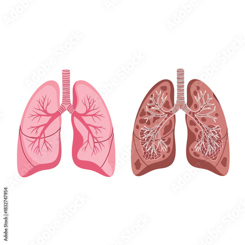 Illustration comparing healthy lungs to lungs damaged by smoking or disease.