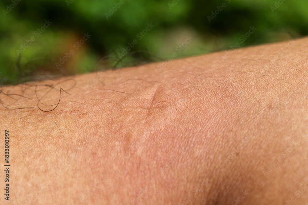 Fototapeta premium Close up of a bump on the skin of the leg marked with an X